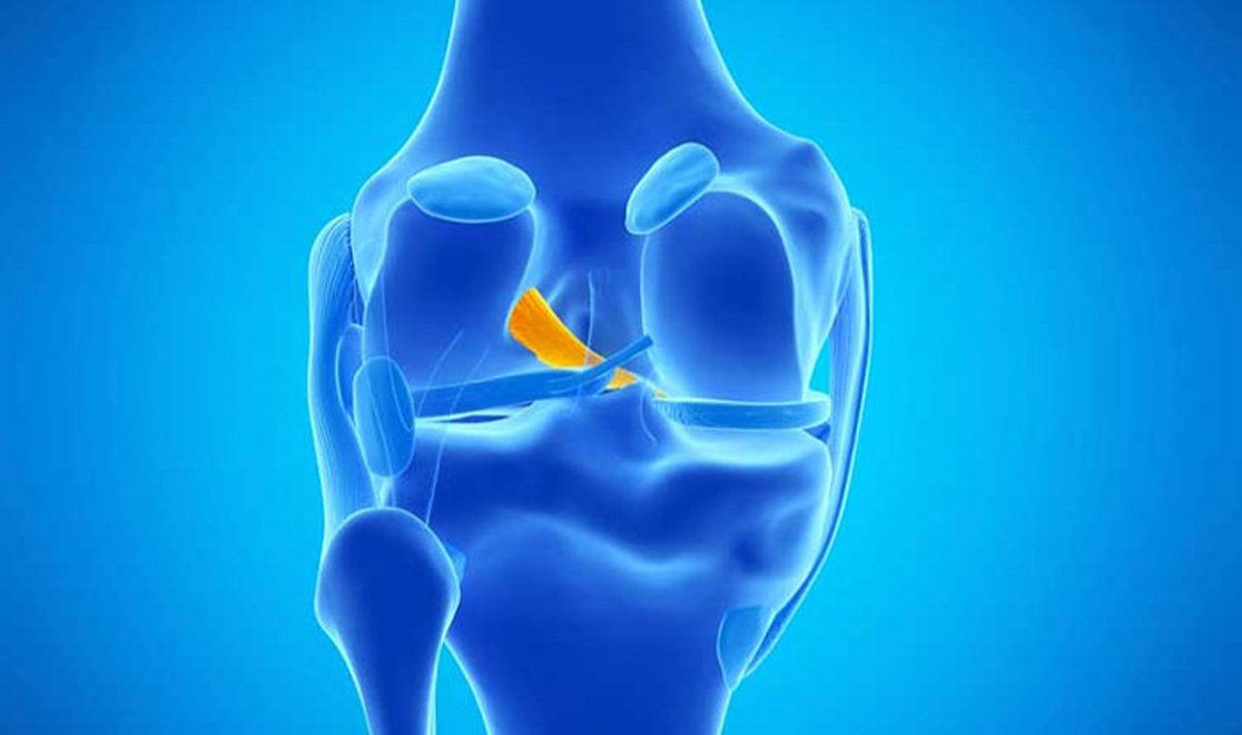 پارگی رباط صلیبی قدامی زانو؛ علائم و درمان کشیدگی و پارگی