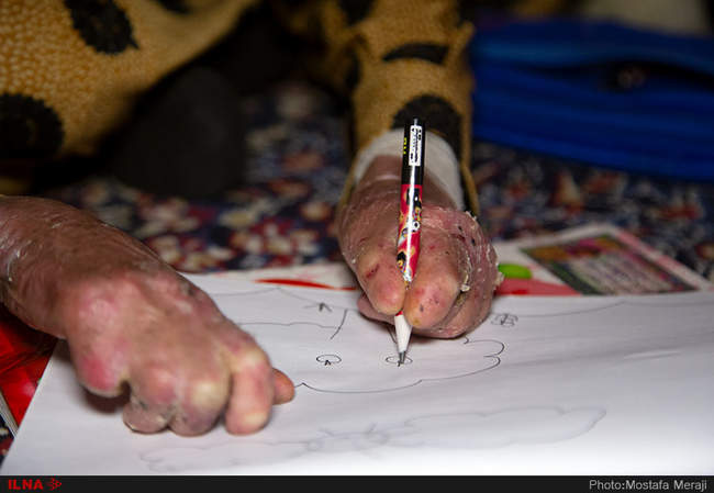 رنج کودکان پروانه ای جنوب کرمان در سایه بی توجهی مسئولین بهداشتی کشو