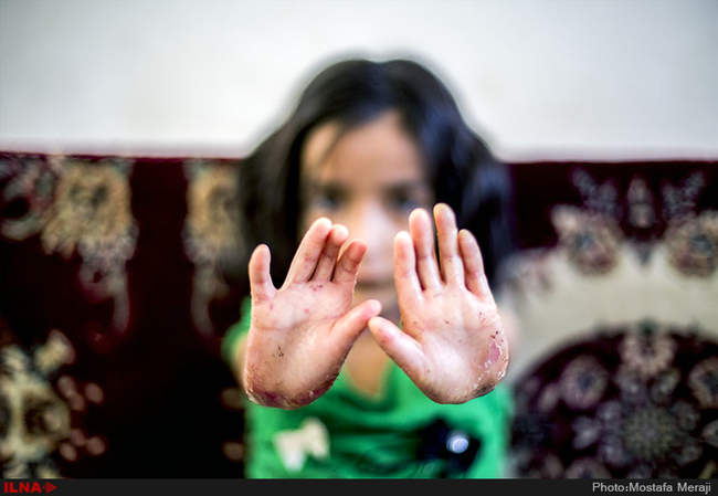 EB، مرگ خاموش کودکان جنوب کرمان