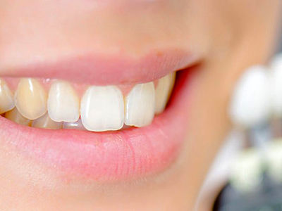 علت زرد شدن دندان‌ها چیست؟ 