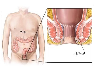 لیزر بهترین روش درمان فیستول مقعدی