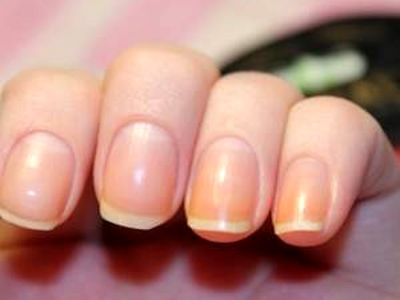 مهم ترین عوامل و علل زرد شدن ناخن های دست و پا