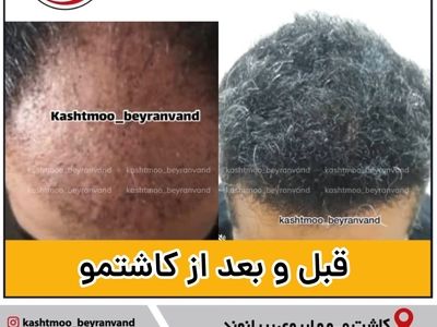 جدیدترین روش کاشت مو برای آقایان