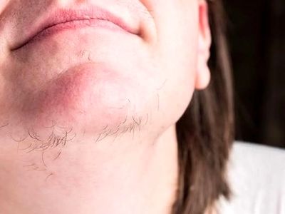 علت رویش موهای زائد زیر چانه چیست؟
