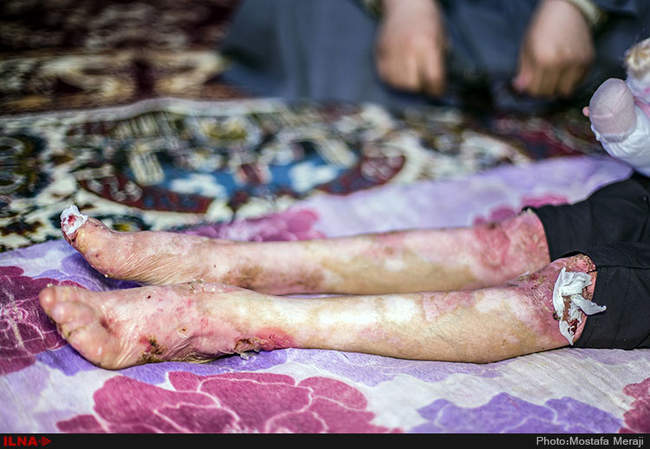 EB، مرگ خاموش کودکان جنوب کرمان