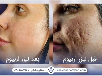 لیزر اربیوم؛ درمان فوری و قطعی جای جوش، حذف تتو و بخیه