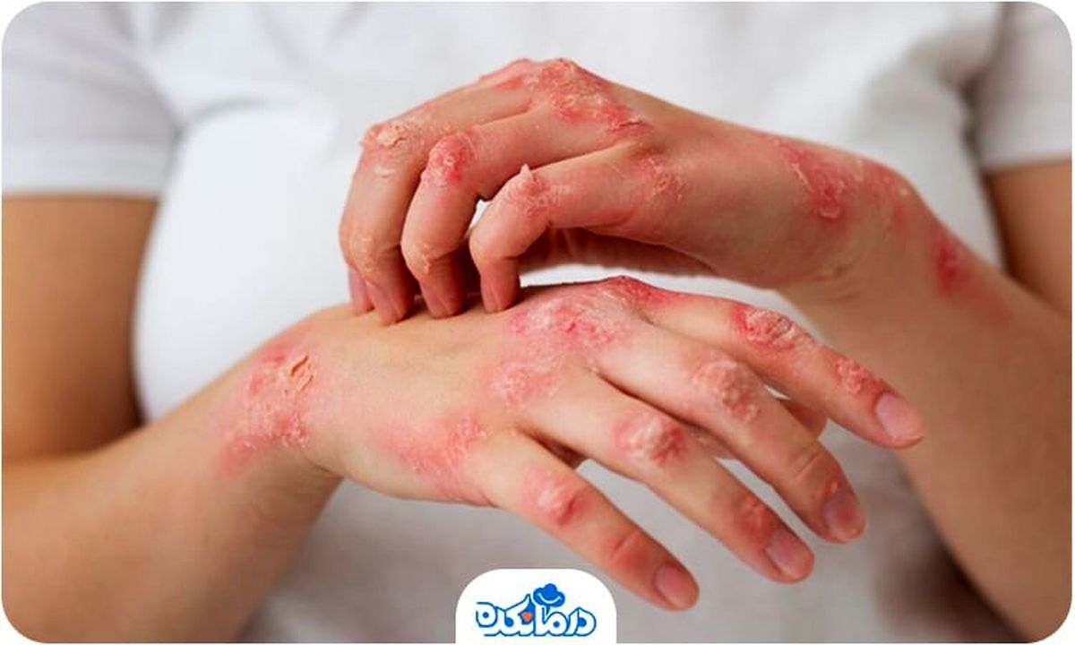 علائم جذام را بشناسید + اینفوگرافیک
