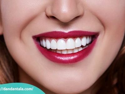 اصلاح طرح لبخند با لمینت یا کامپوزیت کدام یک بهتر است؟