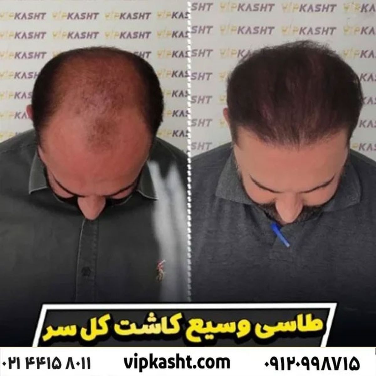 نظر کسانی که کاشت مو انجام داده اند
