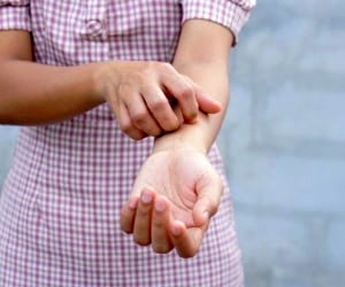 چه نوع خارش پوستی می تواند نشانه ام اس باشد؟