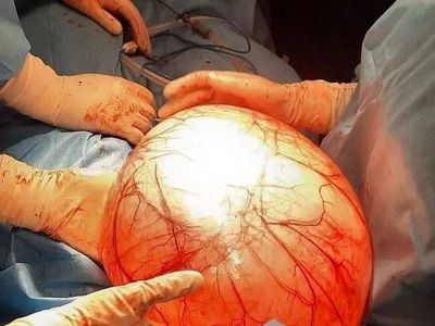 خارج کردن توده ۱۰ کیلوگرمی از شکم یک بیمار در کرمانشاه