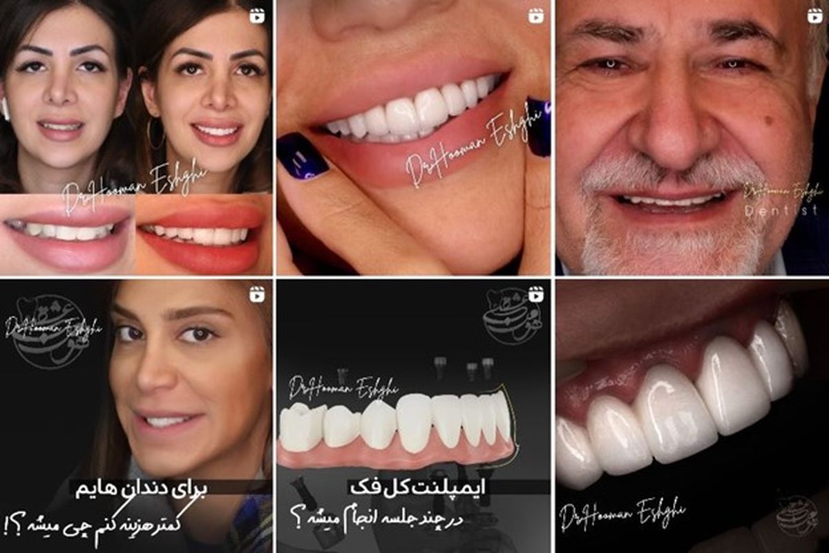 پیج اینستاگرام 5  بهترین "دکترهای کامپوزیت دندان در تهران"