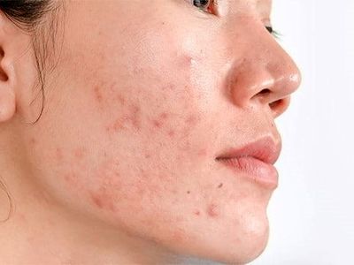 چگونه از شر لکه های سیاه روی پوست خلاص شویم