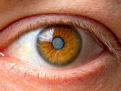 از کجا بفهمیم آب مروارید داریم؟