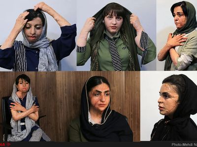 بوی تلخ مهر برای دختران سوخته شین‌آباد؛ ۵ دولت از پس درمان ۱۰ دختر برنیامدند