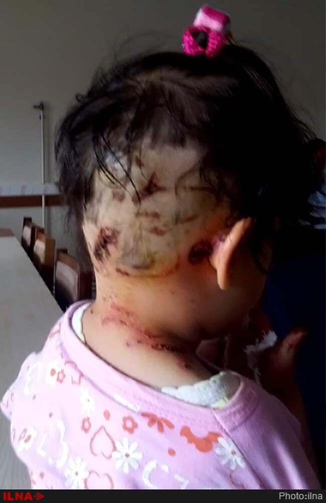 حمله 5سگ ولگرد به دختر بچه چهارساله در روستای یزن آباد از توابع شهرستان نمین استان اردبیل